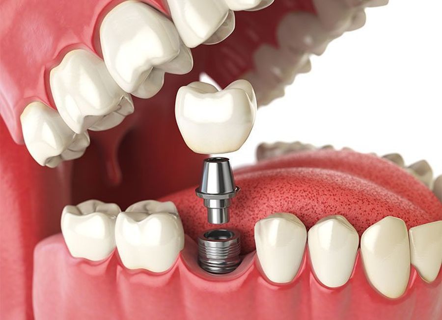 implant dentar, clinica dentara Bucuresti sector 1