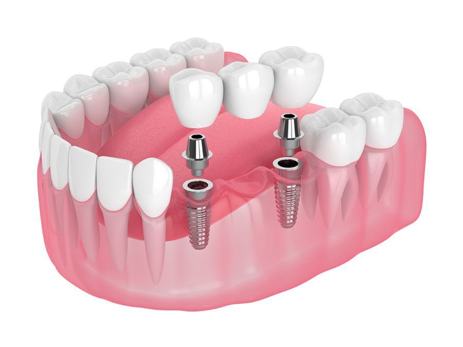 implant dentar Bucuresti, implanturi dentare Straumann, implantologie